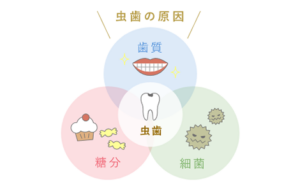 むし歯治療｜あめみや歯科医院